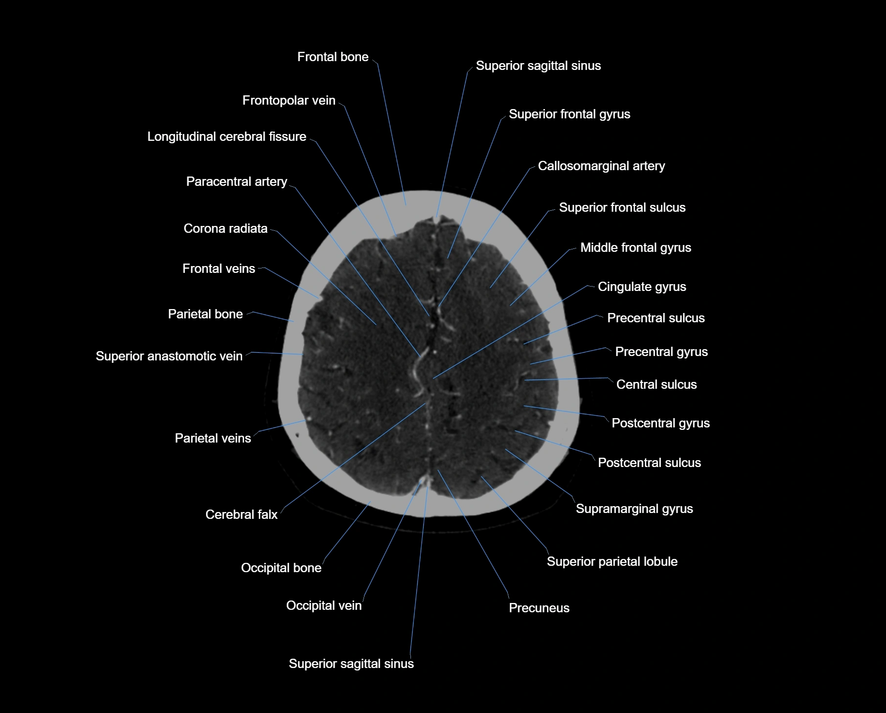 CT scan brain axial labelled cross sectional anatomy image-img-000055.webp